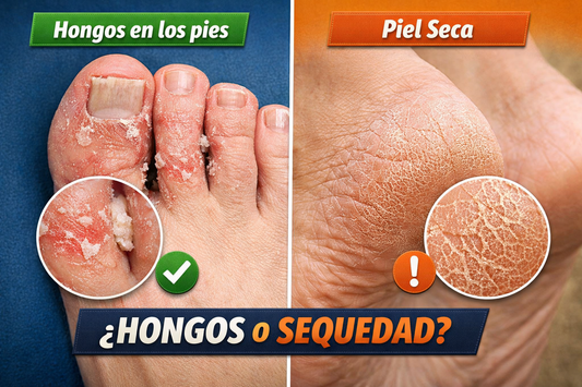 🦶 ¿Hongos en los pies o solo sequedad? Cómo diferenciarlos correctamente