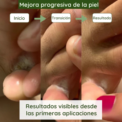 Jabón natural para hongos y sequedad en los pies